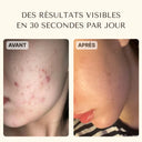 Savon Anti-Acné Chèvre-Olive